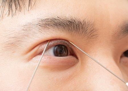 オリジナルの二重まぶた手術“LS法”