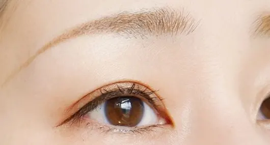 オリジナルの二重まぶた手術 